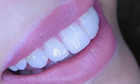white-teeth